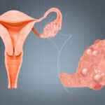 Everything You Need To Know About PCOS