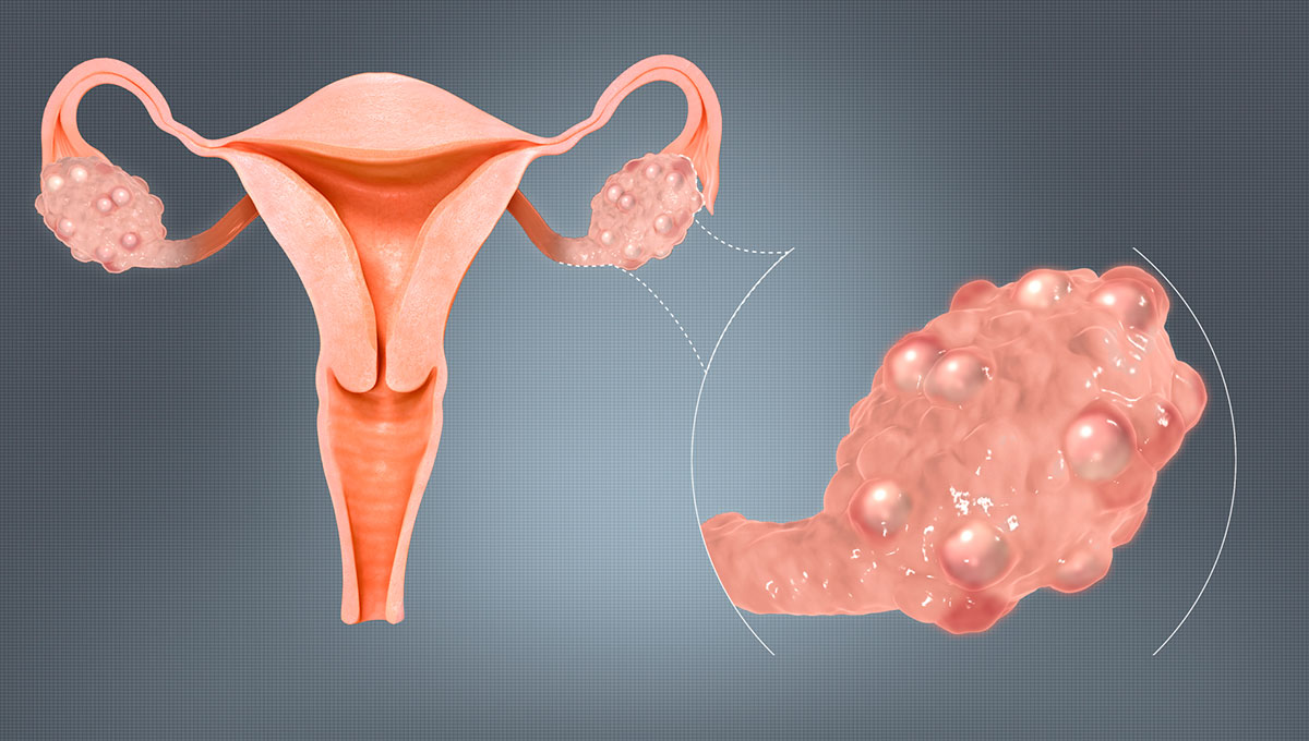 Read more about the article Everything You Need To Know About PCOS