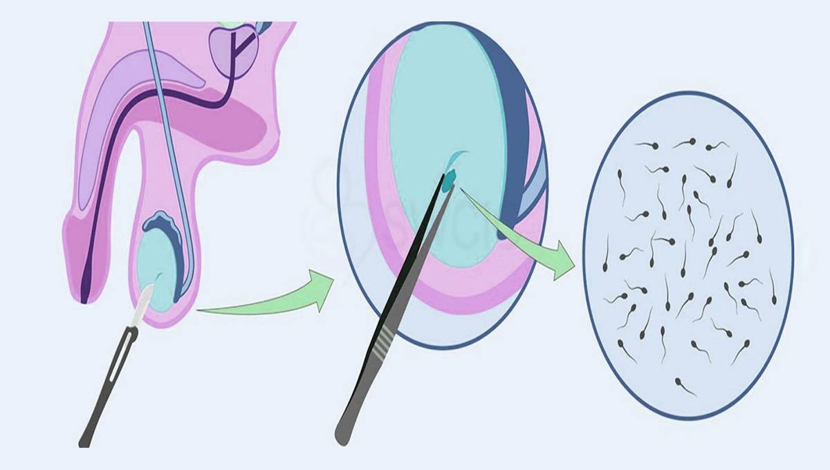 Read more about the article Surgical Sperm Retrieval